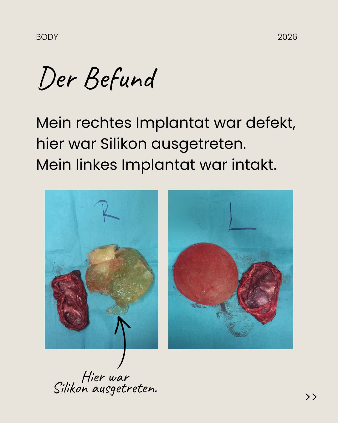 Carousel slide with text: the findings, with photos of the removed implants and capsules, the right one with leaked silicone, the left one intact