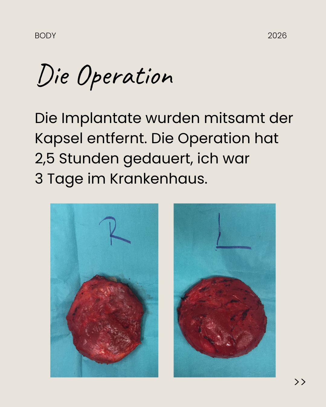Carousel slide with text: details of the surgery, with photos of the removed capsules from the right and left sides