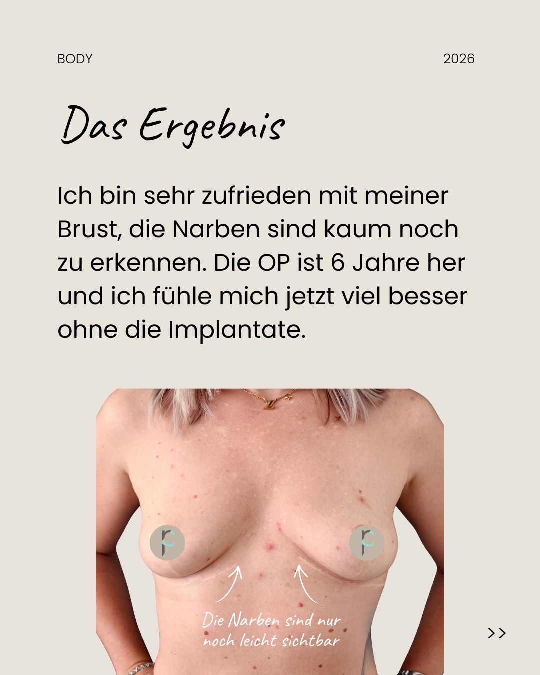 Carousel slide with text: the patient on how she feels six years after the surgery, with a photo of the breasts and arrows pointing to the scars